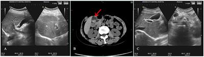 A case report and literature review: one case of ceftriaxone sodium-induced reversible gallbladder stone